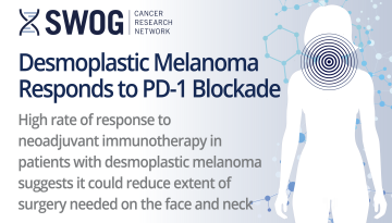 Desmoplastic melanoma responds to PD-1 blockade